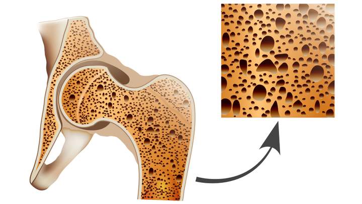 Ursachen Osteoporose